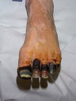 Gangrena Noge Simptomi